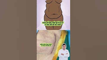 Clip mô phỏng quá trình hút mỡ cắt da tạo hình thành bụng chuyển rốn toàn phần #taohinhthanhbung