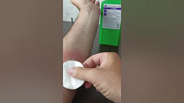 Как избавиться от укуса осы. Полезный лайфхак.