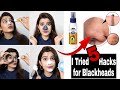 5 Amazing Hacks for Blackheads & Whiteheads | Super Style Tips