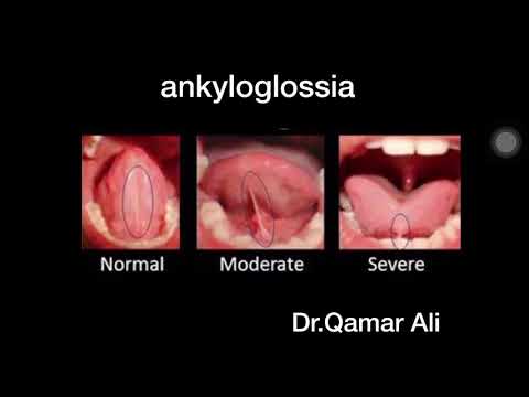 Ankyloglossial اسباب و علاج اللسان المربوط و تأثيرة على النطق