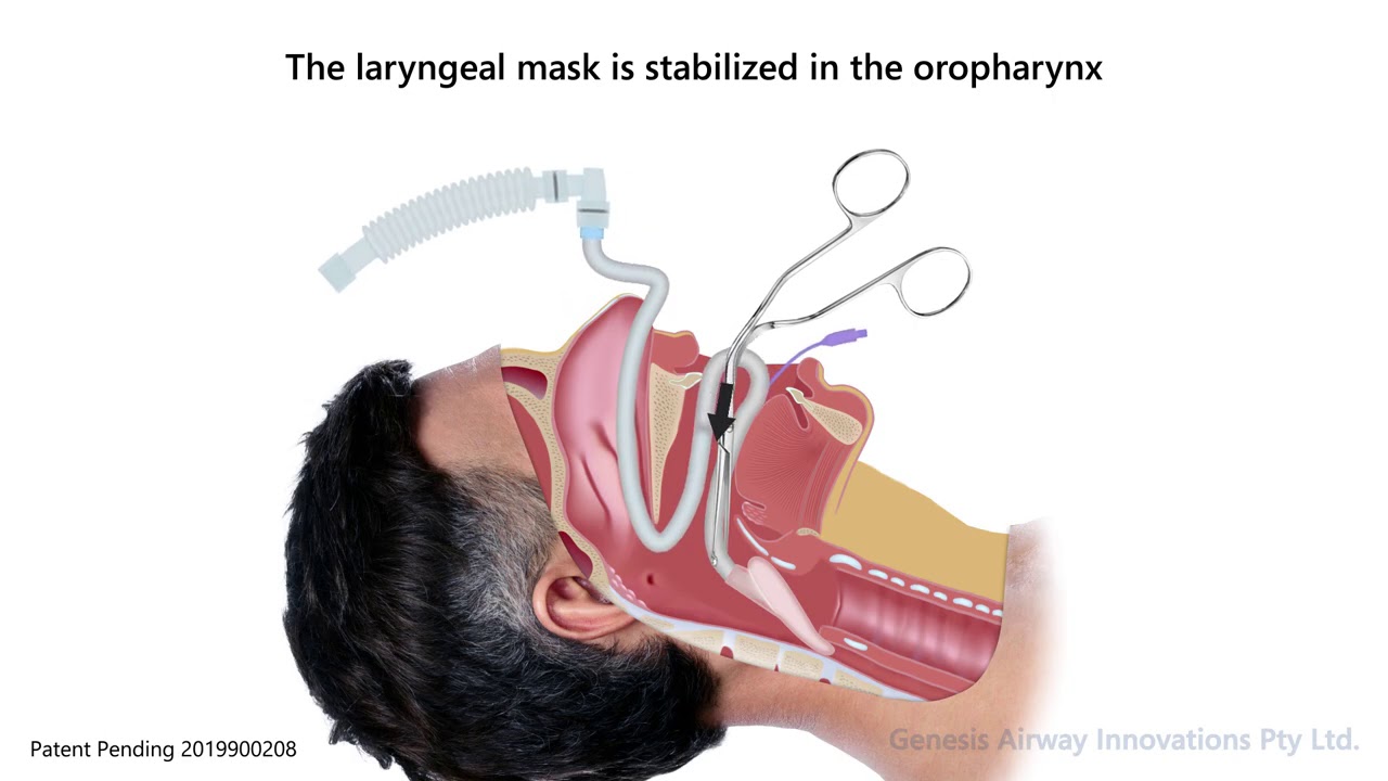 Nasal laryngeal mask airway - YouTube