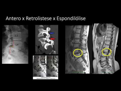 Vídeo: Osteocondrose 1 Grau: Coluna Lombar, Torácica, Cervical