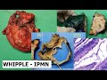 Whipples procedure  ipmn 1