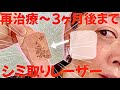 【シミ治療】シミ復活?肝斑?再治療〜3ヶ月後の経過をお見せします!