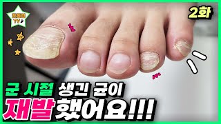 (eng sub)[2편]구독자분께서 방문해 주셨어요 ㅎㅎ｜레푸스 서면점/사상점｜ingrown toenail｜Athlete&#39;s foot-Fresh Foot