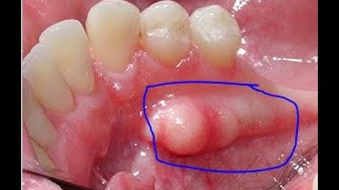 Excision of Bone CPT code - simplify medical coding