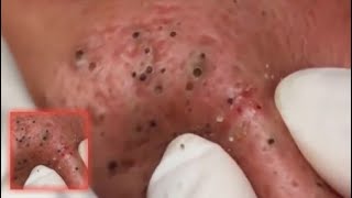 How to Removal Cystic Acne Treatment Blackheads On The Face Easy (Part 5)