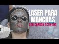 Laser Para Manchas - Hollywood Laser con carbón activado