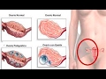 Home remedy to clean uterus, ovaries and eliminate cysts ...