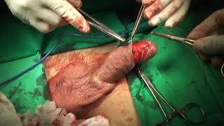Como funciona a cirurgia de vasectomia?