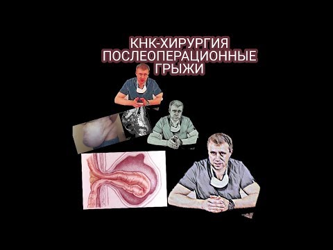 Послеоперационная грыжа