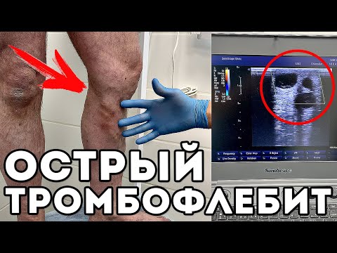 ОСТРЫЙ ТРОМБОФЛЕБИТ. Осложнение