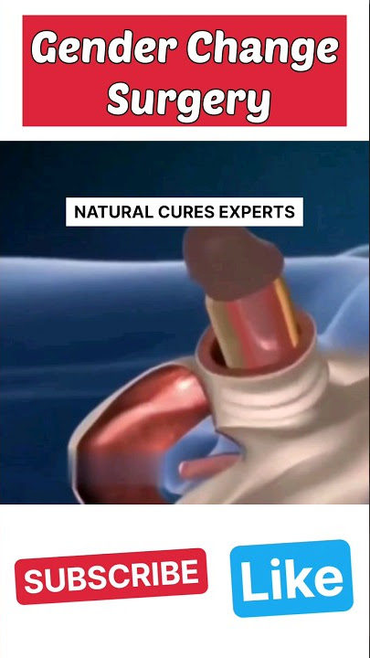 Male to female gender reassignment surgery! #shorts #male #female #shortsvideo #shortsvideo #viral