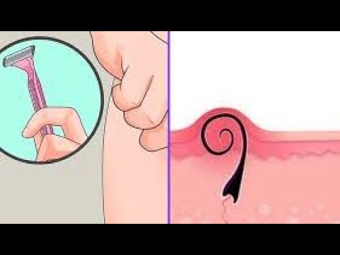 ازاله شعر المناطق الحساسه التخلص من شعر لمده طويله - YouTube