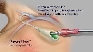 PowerFlow Implantable Apheresis IV Port Access Video