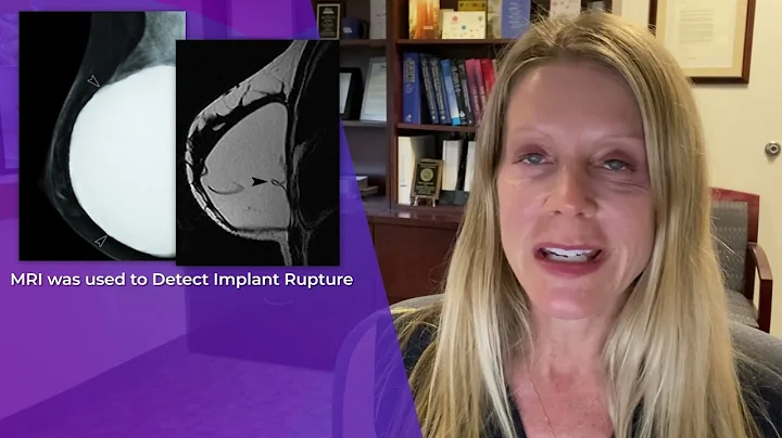 Ultrasound and Breast Implant Silent RuptureVideo ...
