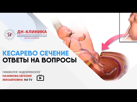 Кесарево сечение - Ответы на вопросы. Доктор Назимова