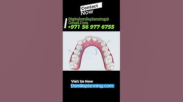 Unlock Your Perfect Smile with Digital Smile Planning #clearaligners #clearsmile #invisalign 4