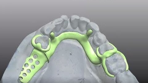 3Shape CAD training for a lingual bar RPD-#1