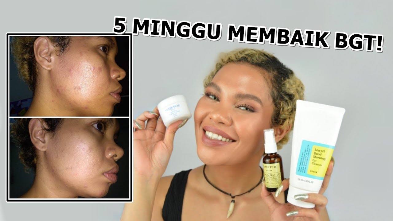 SKINCARE GUE UNTUK JERAWAT, BEKAS JERAWAT, KUSAM, DAN