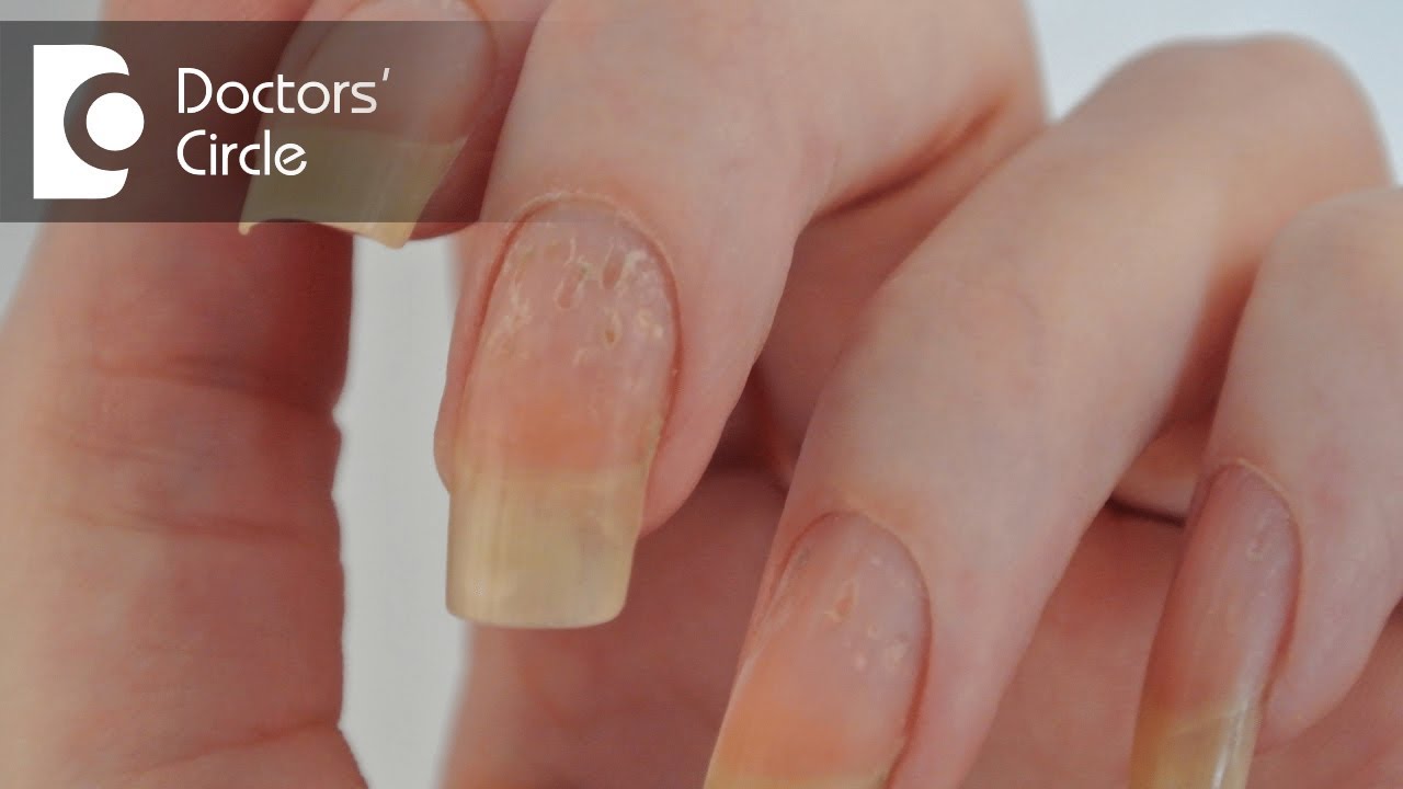 Living with Nail Psoriasis: Practical Tips for Daily Management