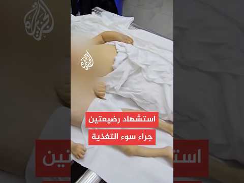 مستشفيات غزة توثق وفاة ثلاثة أشخاص بسبب سوء التغذية