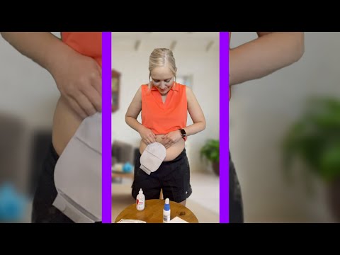 Video: 3 Cara Berpakaian dengan Ostomy