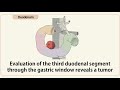 Evaluation Of The Third Duodenal Segment Through The Gastric Window Reveals A Tumor Evaluation Of The Third Duodenal Segment Through The Gastric Window Reveals A Tumor