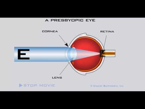 Video: Rawatan Farmakologi Presbyopia: Kajian Semula Perspektif Moden