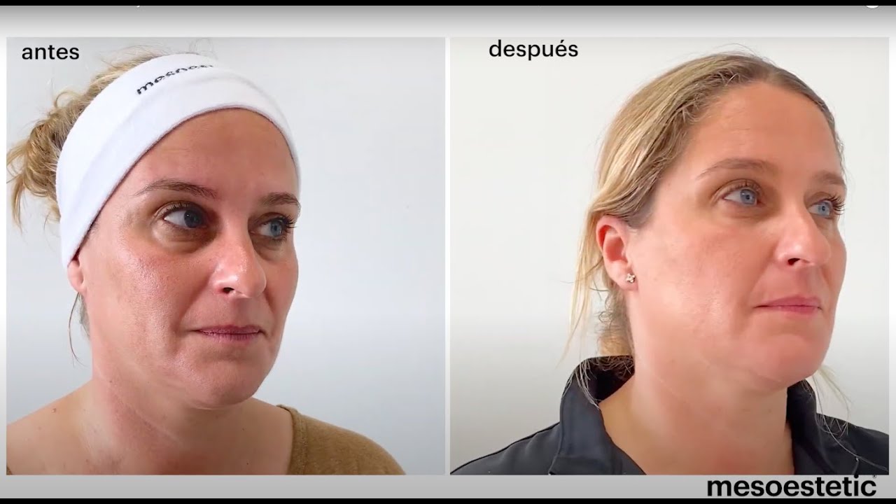 Tratamiento de ojeras con acido hialurónico -Treatment of dark circles | Dr. Martin Gaston Alvarez
