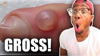 PIMPLE POPPING COMPILATION (kids not allowed)