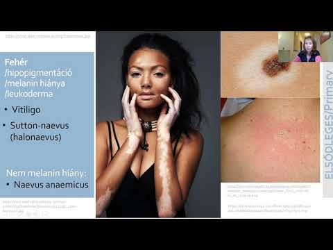 Videó: Hemangioma - Az Orvosi Szakkifejezések Szószedete