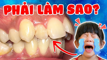 Niềng Răng Hô Cho Trẻ Em: Phương Pháp Niềng Răng Hô Cho Trẻ Em nào Hiệu Quả Nhất?