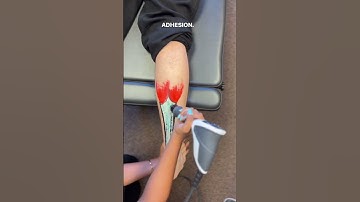 What is the fastest way to heal the Achilles tendon? Shockwave Therapy!