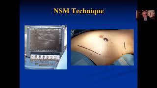 NIPPLE SPARING MASTECTOMY A technical overview with Dr Jay Harness