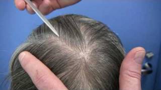 Dr Wong  Hair Transplant - 2319 grafts - 1 Surgery