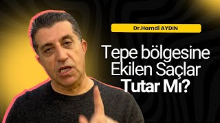 Tepe Bölgesine Ekilen Saçlar Tutar Mı? Detaylı Açıklıyoruz