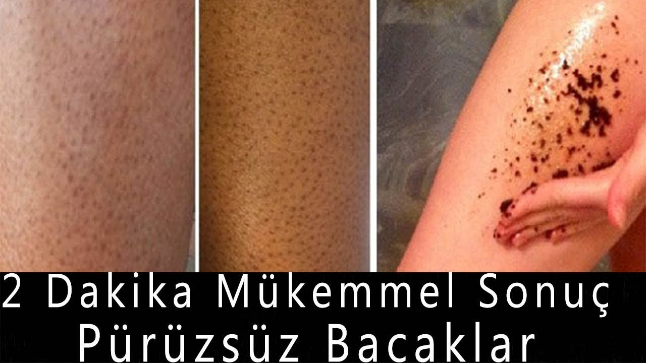 bacak batiklarina son purussuz bacaklar icin kahve peelingi youtube