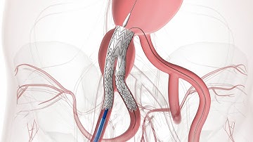 ANIMATION - GORE® EXCLUDER® ILIAC BRANCH ENDOPROSTHESIS