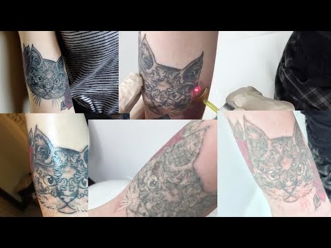 Laser Tattoo Removal Journey - BEFORE & AFTERS