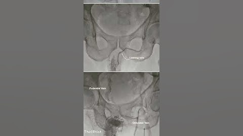 Treatment of Erectile Dysfunction due to Venous leakage