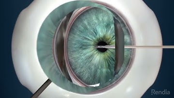 iStent Inject® animated video