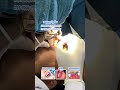 Root Canal Treatment Anterior Tooth by Khmer Teeth Dental Clinic #ពេទ្យធ្មេញខ្មែរធីស #dentist