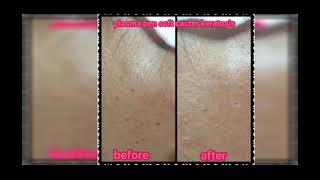 Plasma Pen Soft Cauter Keratosis Ivy Klinik Kecantikan Cikarang | Mahveen Skincare screenshot 1