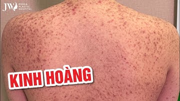 BIẾN CỰC CĂNG: BIẾN CHỨNG, TỬ VONG vì CẢ XÓM rủ nhau tiêm SILICON LỎNG hàng Thái "XÁCH TAY"