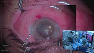 PKP and mature cataract Lukan Mishev Live Stream