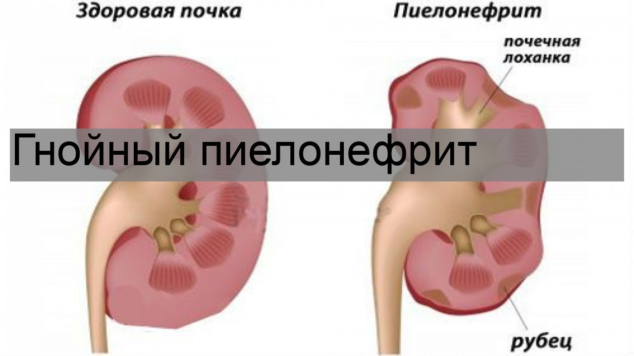 Острый гнойный пиелонефрит. Мкб 10 пиелонефрит Гнойный. Лечение Гнойного пиелонефрита. Профил пиелонефр меропр. Этиотропное леч пиелонефр.