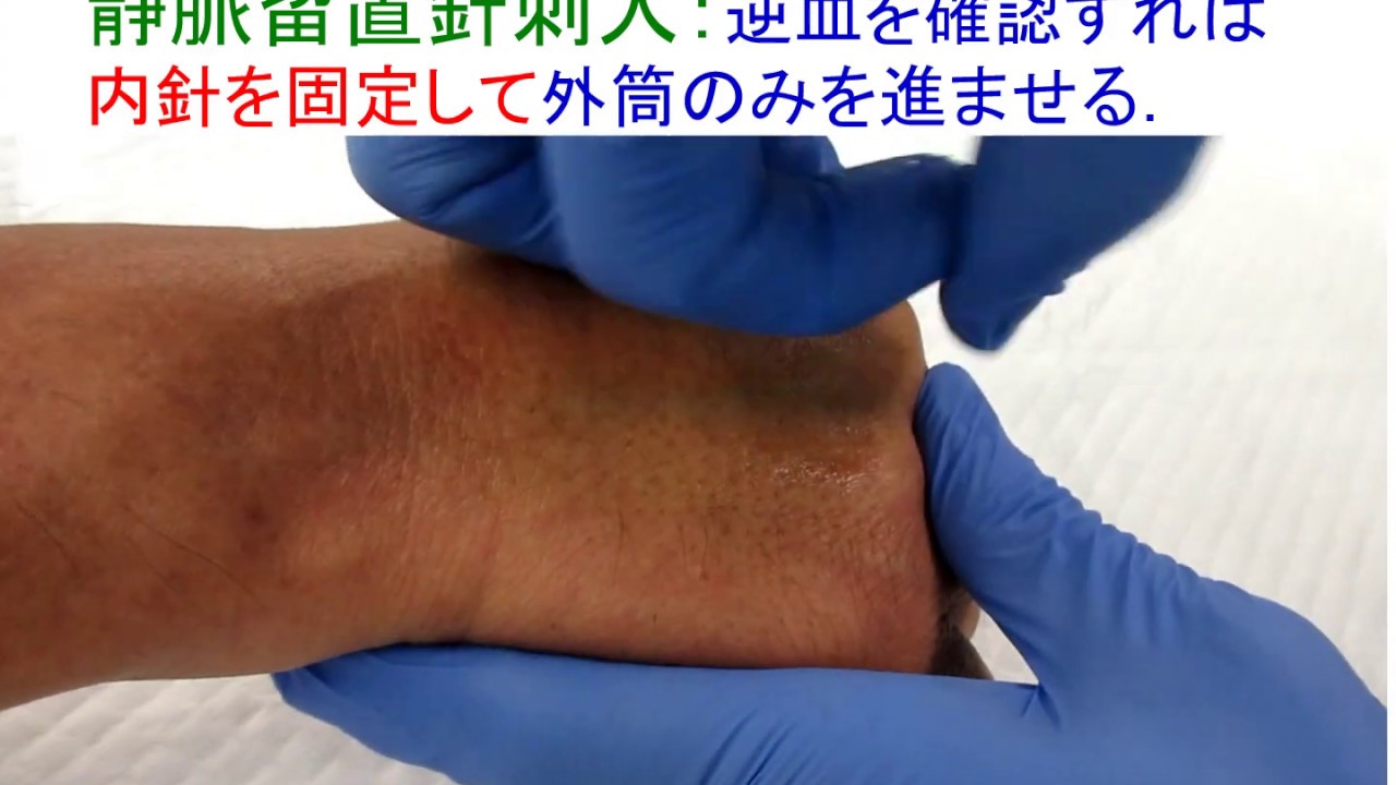 12分57秒）静脈留置針穿刺時のコツA