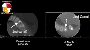 J. Morita X800 Vs Carestream 9000 3D