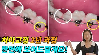 치아교정 2년 과정을 이 영상에 모두 담았습니다^^